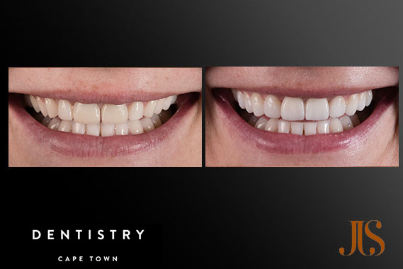 Implant Reconstruction