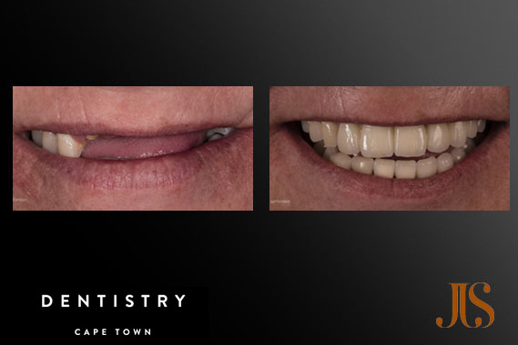 Implant Reconstruction