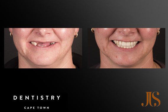 Implant Reconstruction