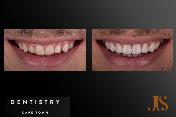 Cosmetic Dentistry Cape Town