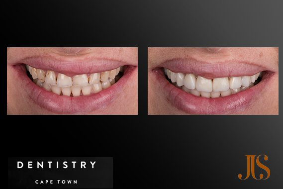 Cosmetic Dentistry Cape Town
