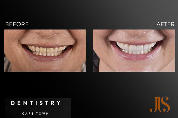 Dental Implants Cape Town