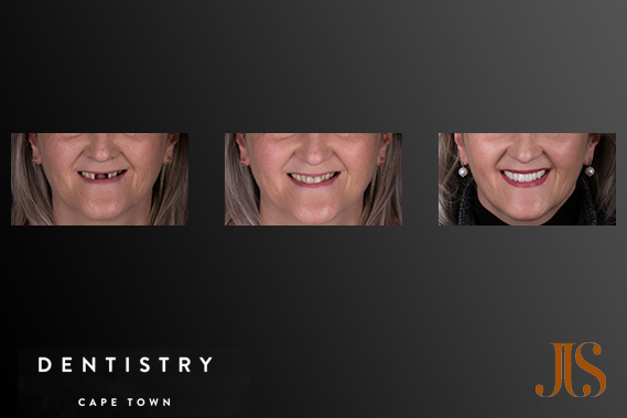 Dental Reconstruction