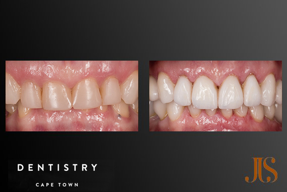 Dental Reconstruction