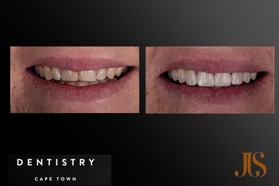 Teeth Veneers