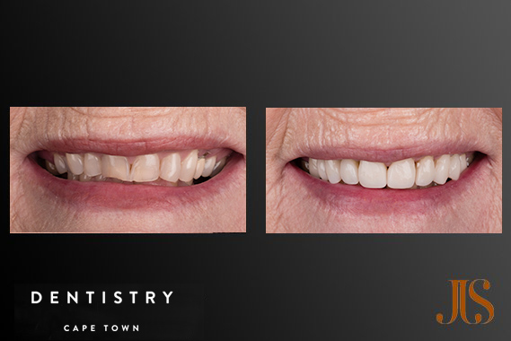 Teeth Veneers