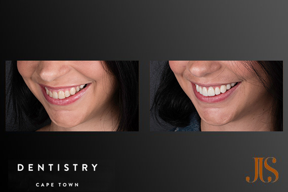 Smile Makeover South Africa