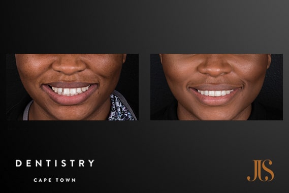 Orthodontist in Cape Town | Dr JJ Serfontein