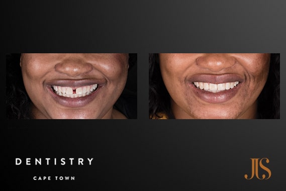 Dr JJ Serfontein | Orthodontist