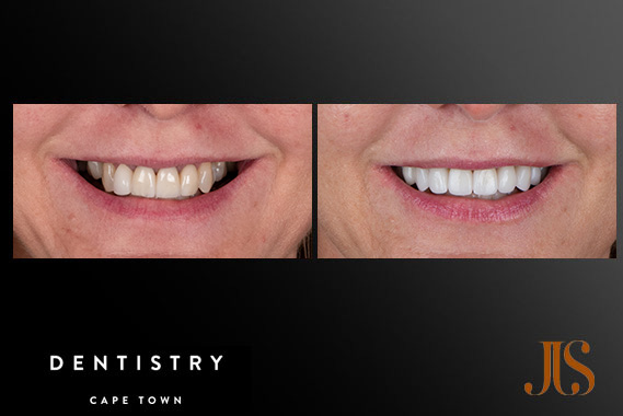 Implant Reconstruction