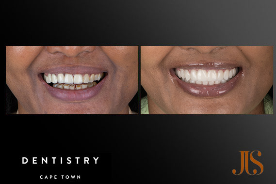 Implant Reconstruction