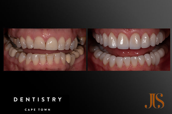 Implant Reconstruction