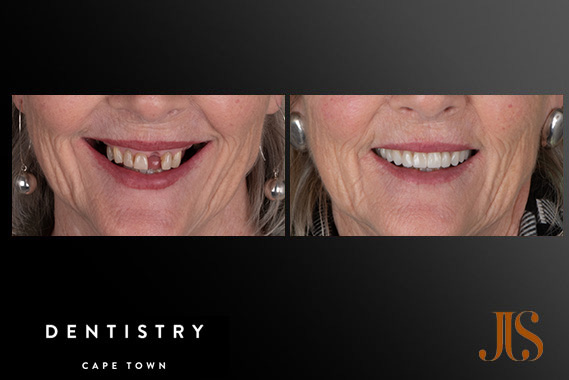 Implant Reconstruction