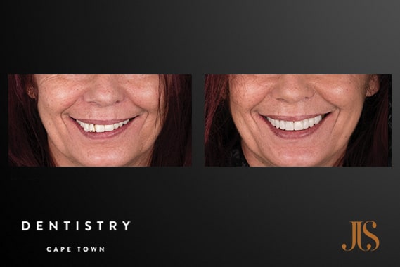Dental Implants Cape Town | JJS Dentistry