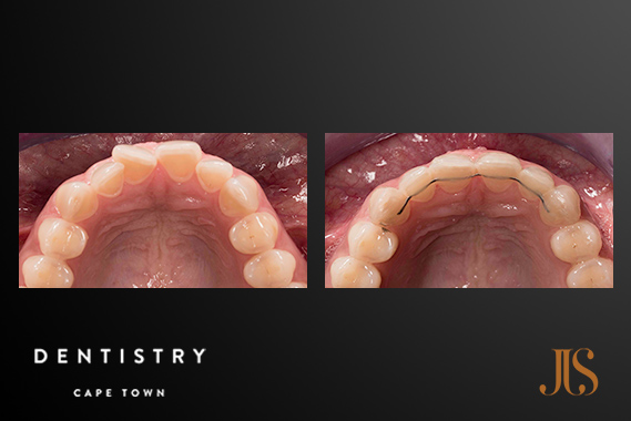 Short Ter, Adult Orthodontics