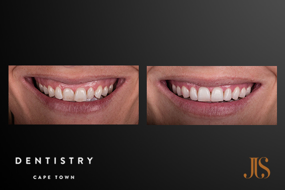 Cape Town Orthodontics For Adults