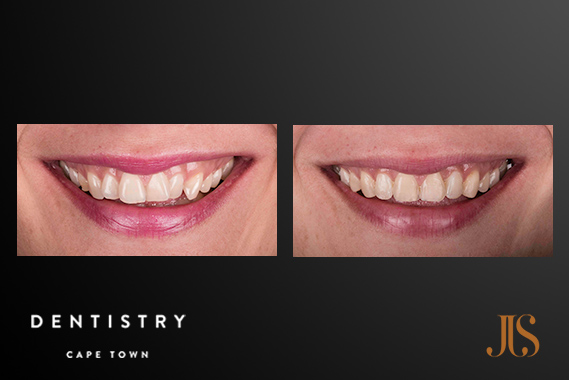 Short Term Adult Orthodontics