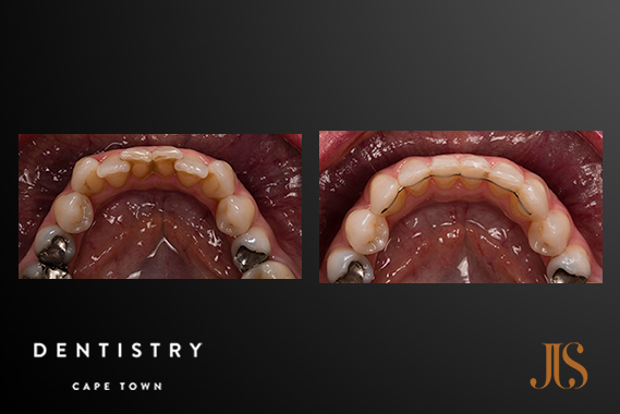 Orthodontics For Adults