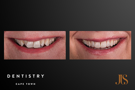 Short Term Adult Orthodontics