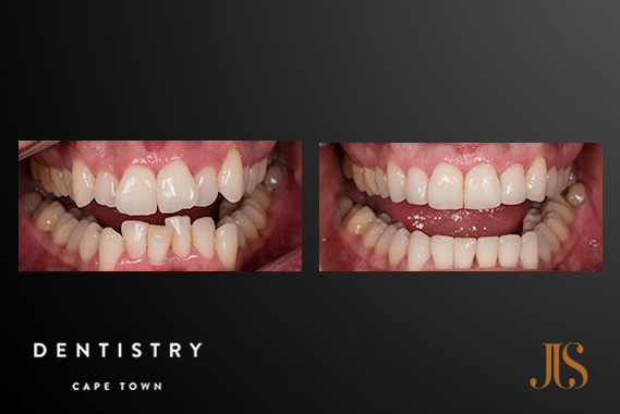 Short Term Orthodontics