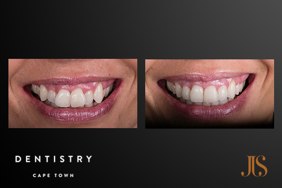 Short Term Adult Orthodontics