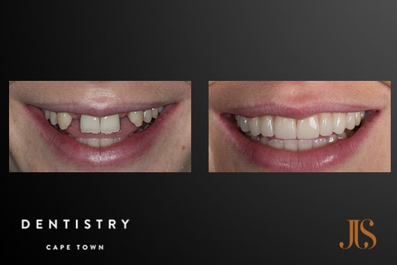 Smile Makeover - Resin | Dr JJ Serfontein