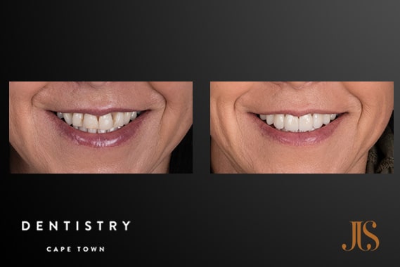 Dr JJ Serfontein | Smile Makeover - Resin