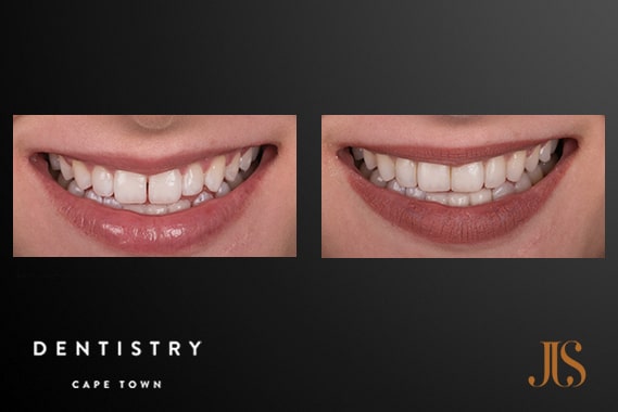 Smile Makeover - Resin | Dr JJ Serfontein