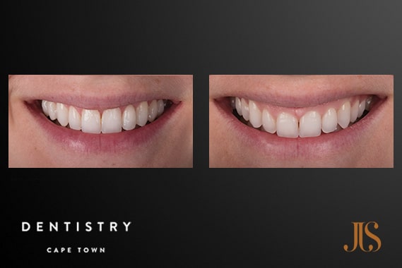 Dr JJ Serfontein | Smile Makeover - Resin