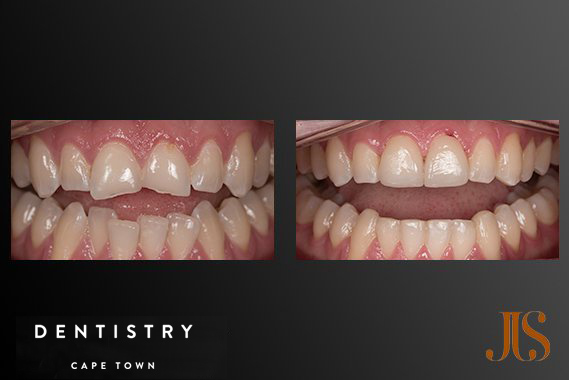 Dental Reconstruction