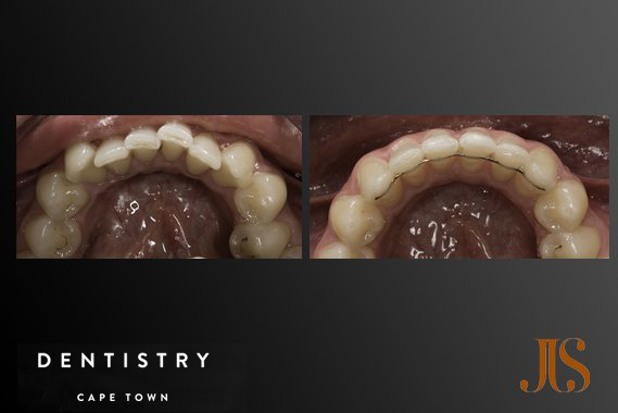 Smile Makeover South Africa