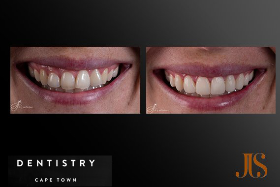 Dental Veneers