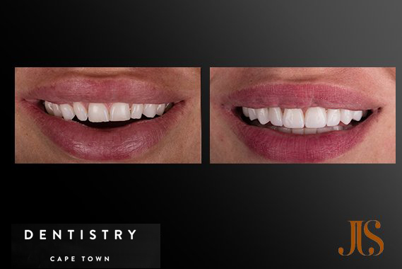 Smile Veneers