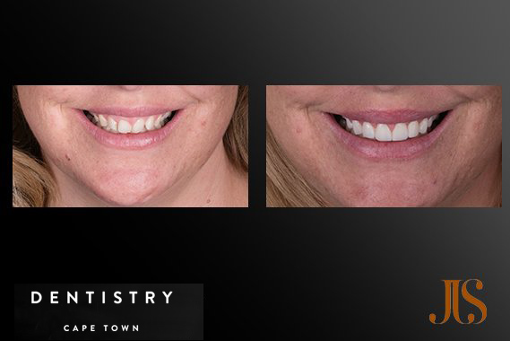 Smile Veneers