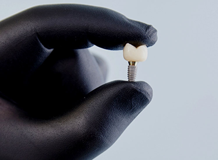 Dental Implants | Implant Dentist Cape Town