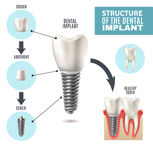 How do dental implants work?