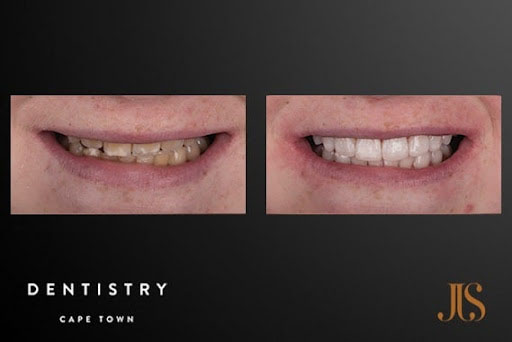 Internation Patients Case 1 | JJS Dentistry